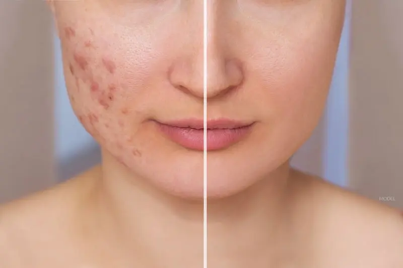 Acne Scar Treatment