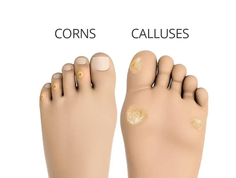Corns & Calluses