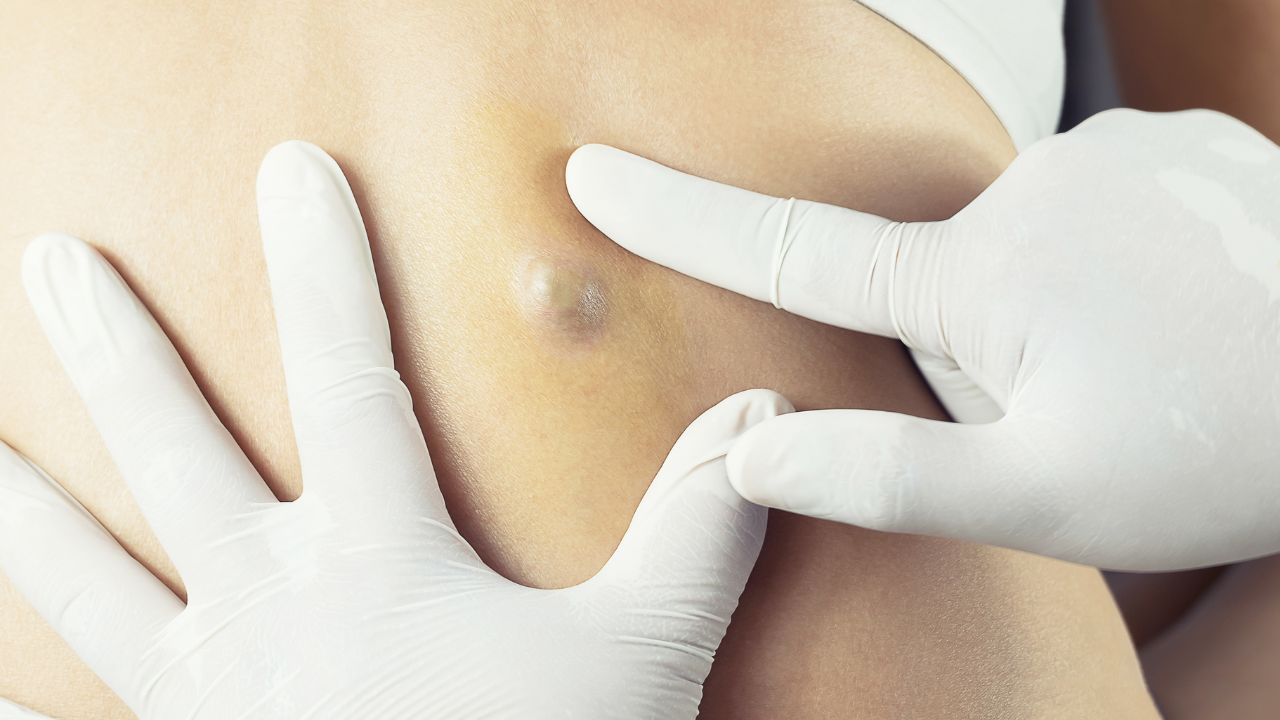 Cyst Excision
