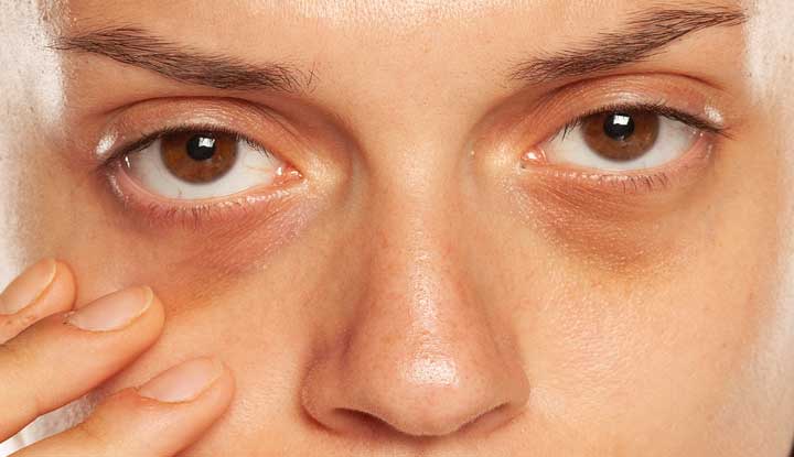 Dark Eye Circles
