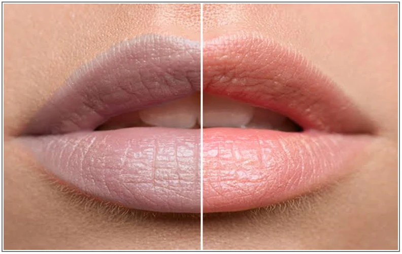 Dark Lips Treatment