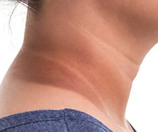 Dark Neck Pigmentation
