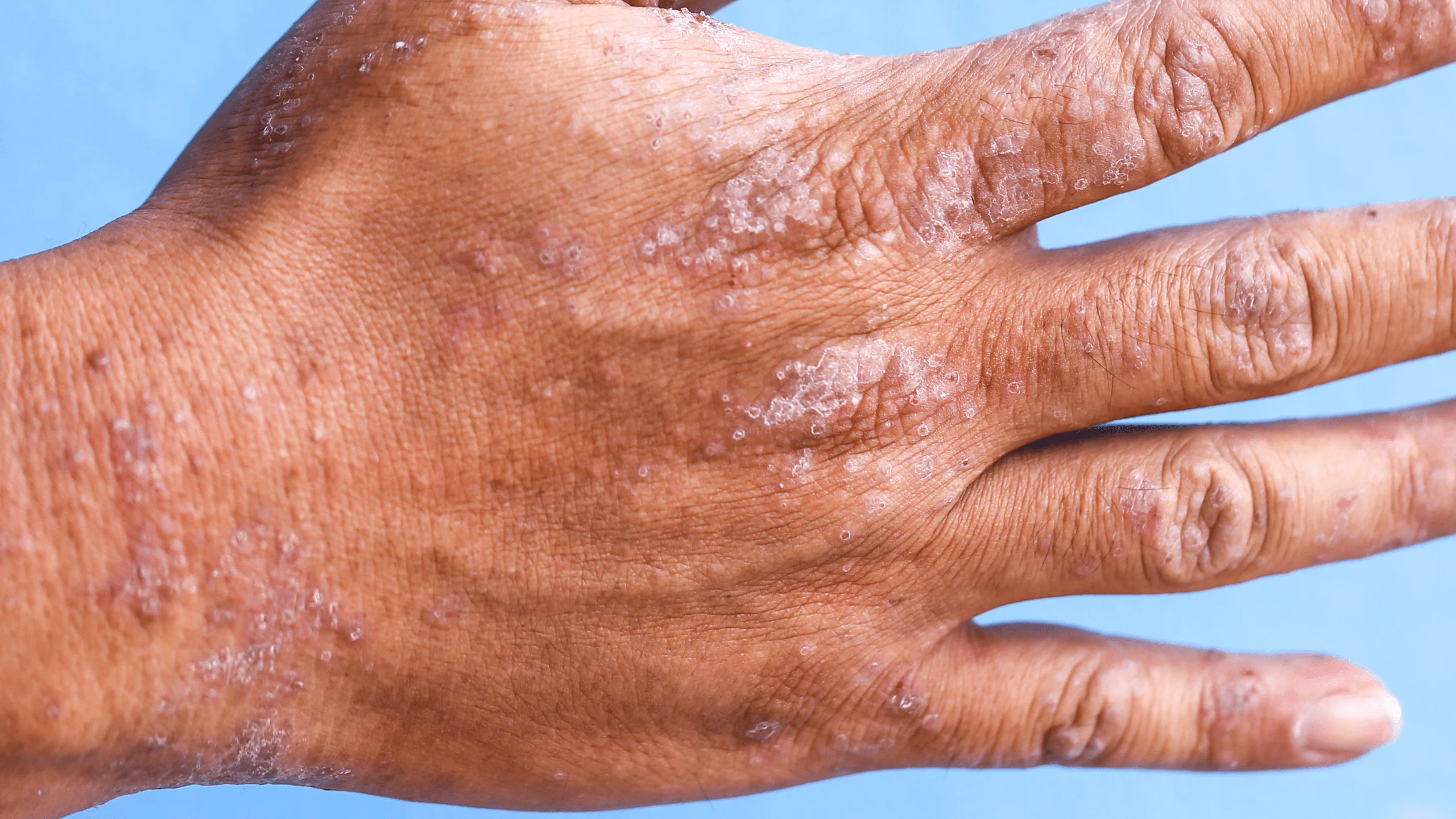 Eczema