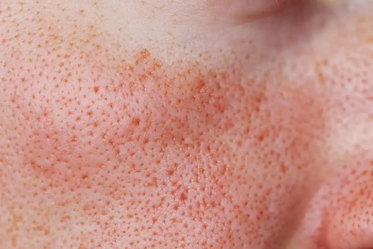 Enlarged pores