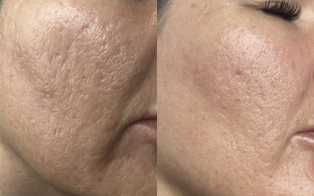 Fractional CO2 Lasers