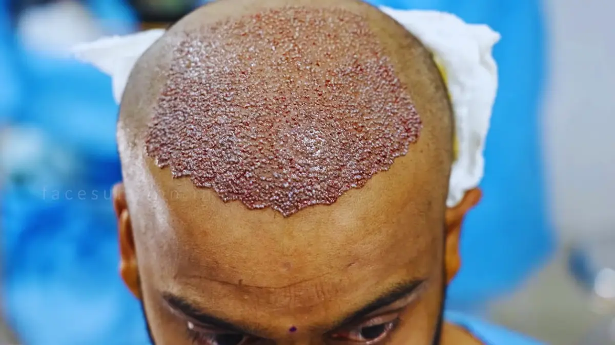 Hair Transplant