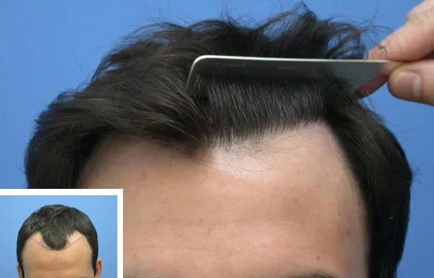 High Density Hair Transplant