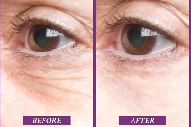 Jovilift eye tightening