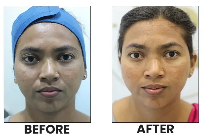 Laser Skin Lightening