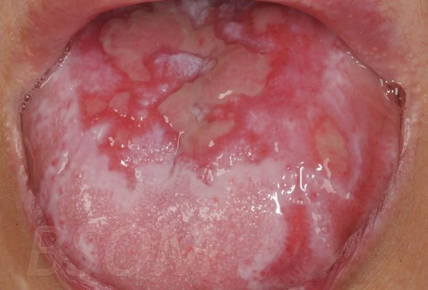 Lichen Planus