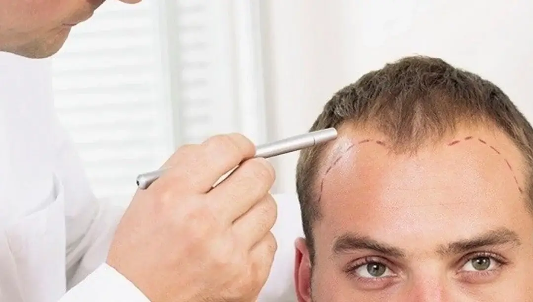 Micro FUE Hair Transplant