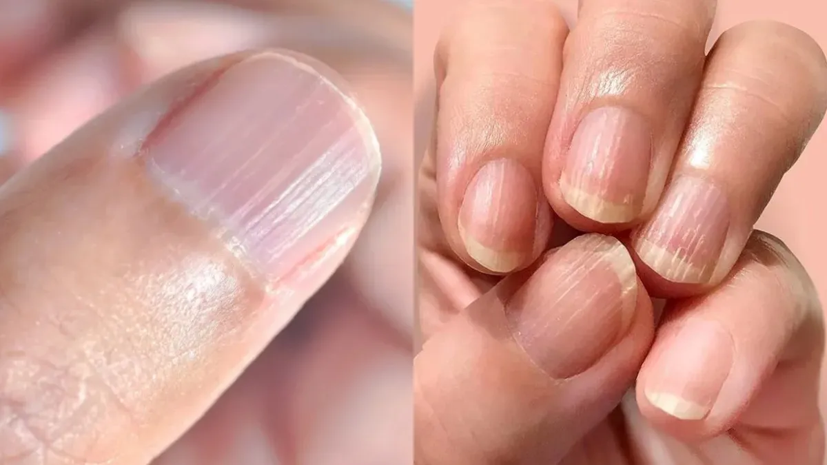 Nail Problems