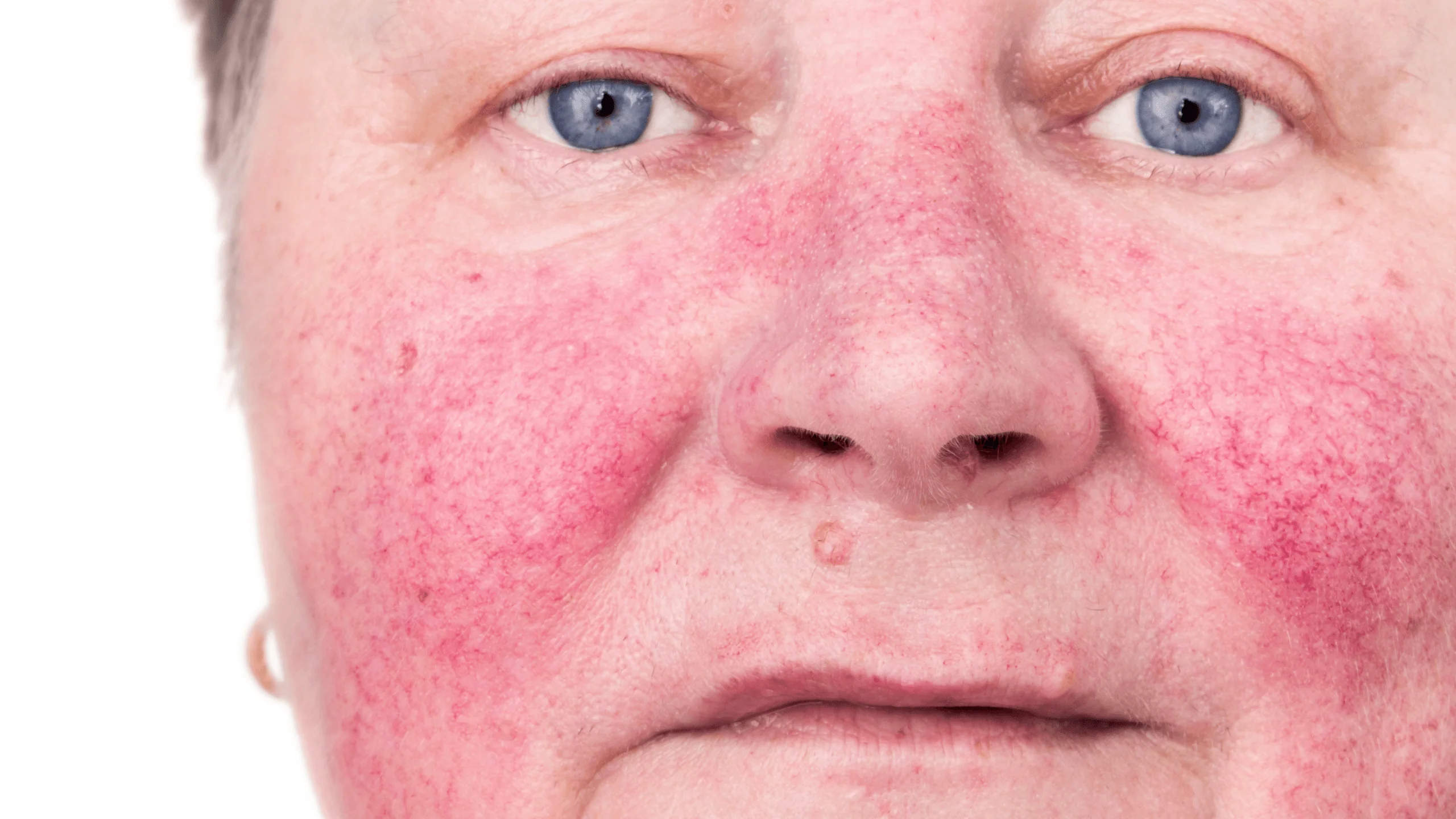 Rosacea