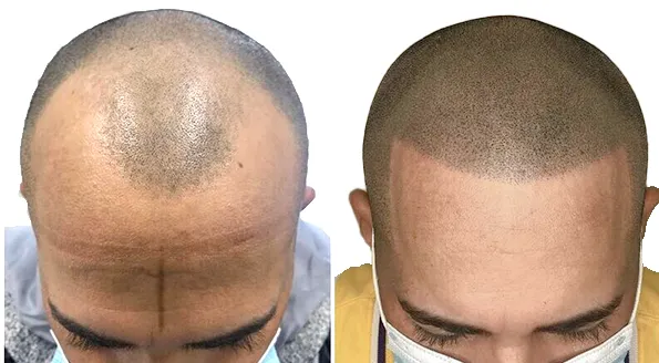 SMP (Scalp Micro Pigmentation)