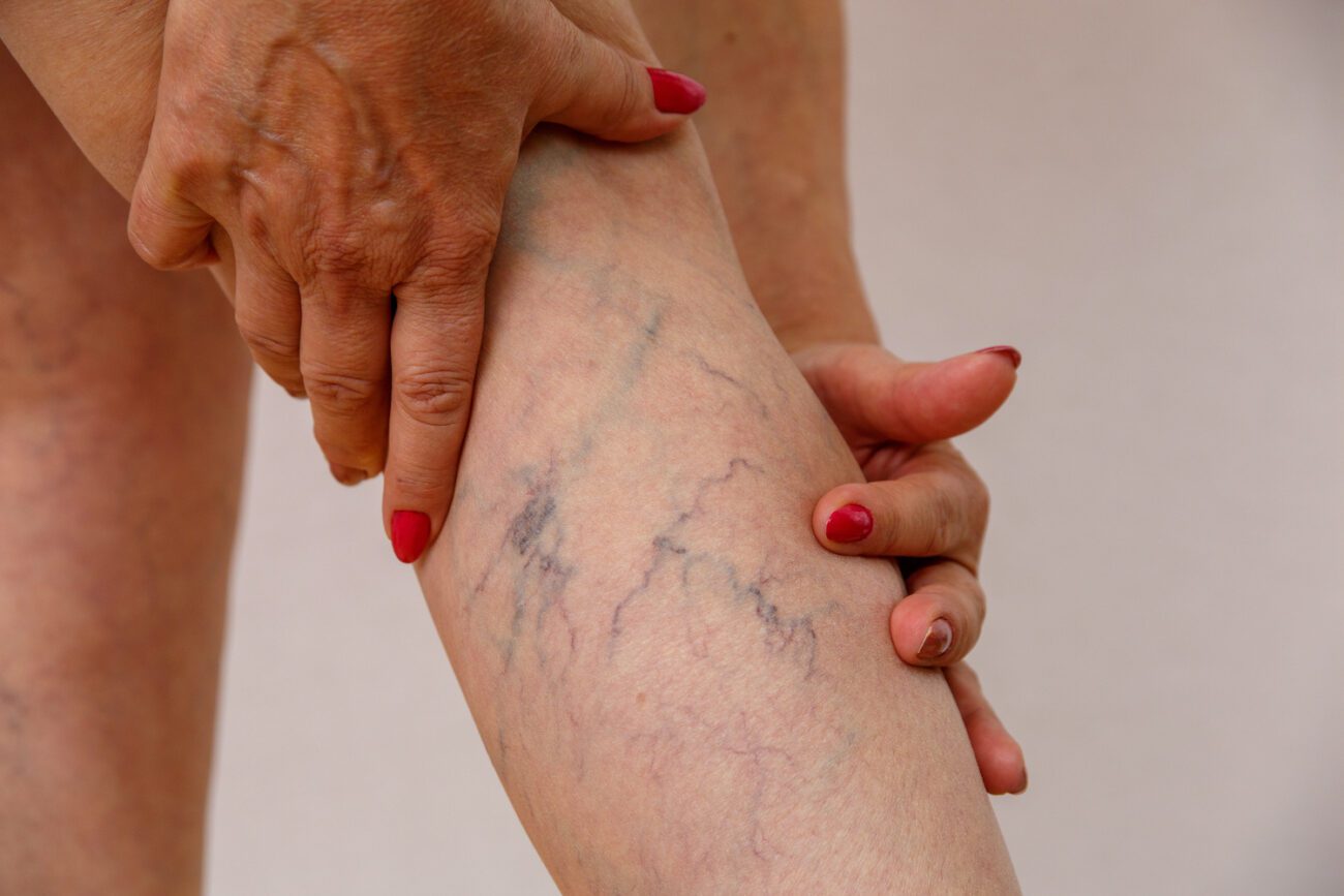 Spider Veins