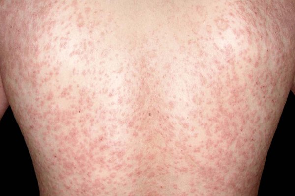Understanding Pityriasis Rosea