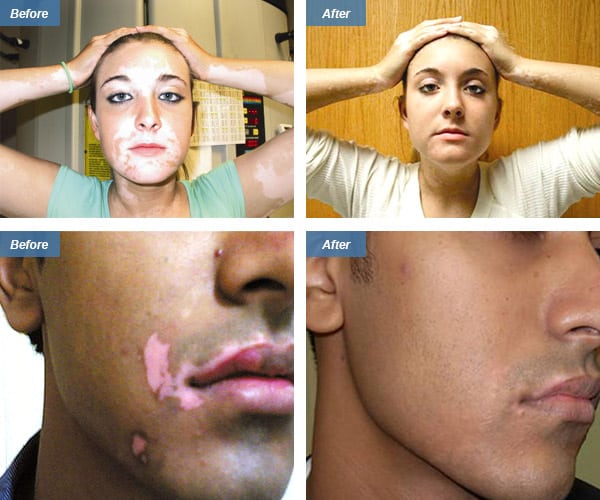 Vitiligo Laser Treatment