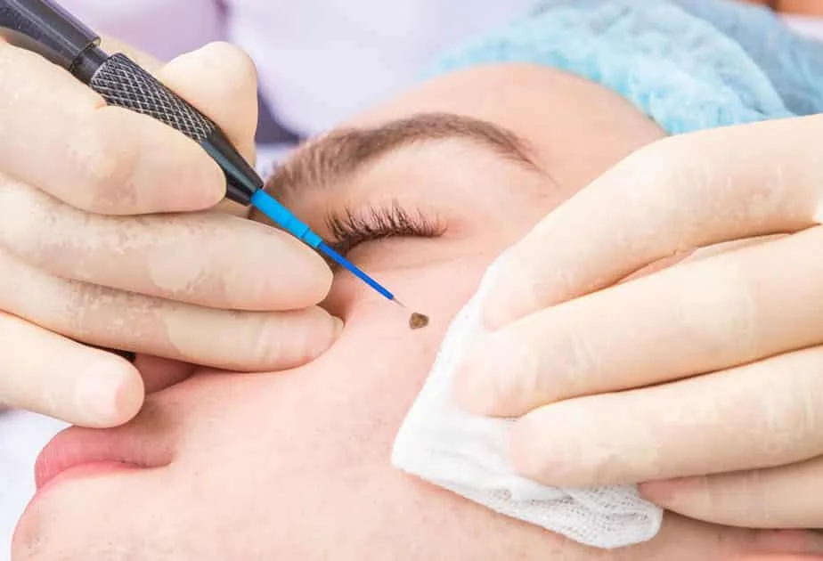 Wart Removal Treatment