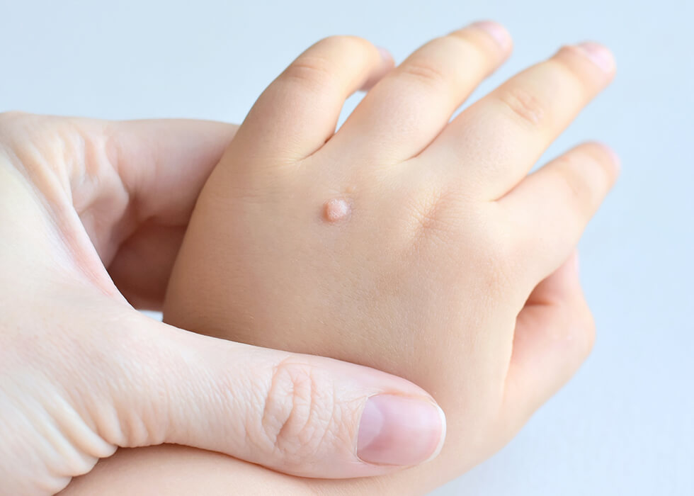 Warts