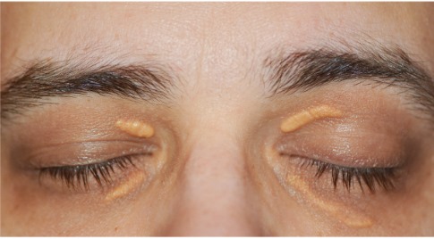 Xanthelasma