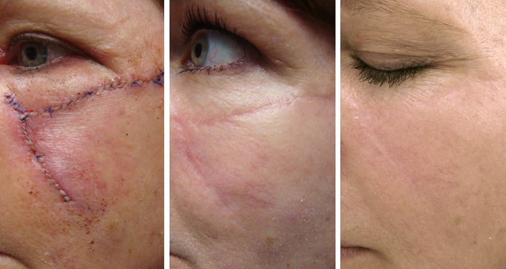 scar revision