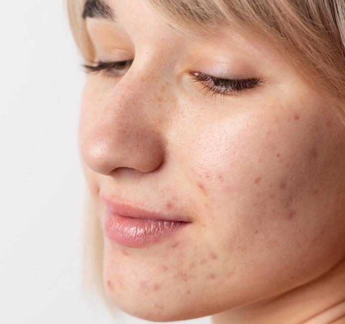 Acne Scar Treatment in Raipur