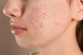 Acne Treatment in Rewa – Expert Care by Dr. Ayesha Faizan