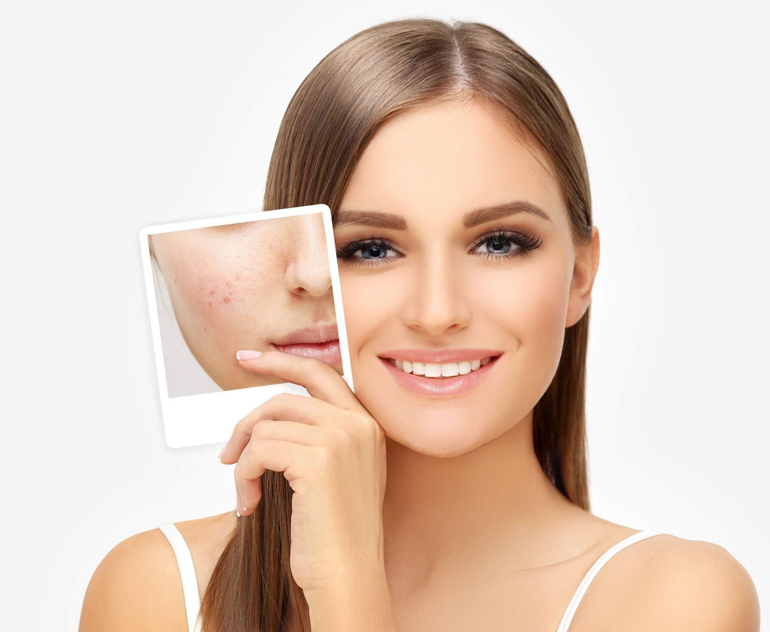 Acne Treatment In India