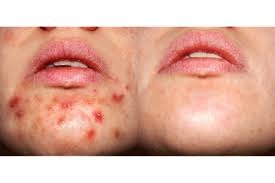 Acne Treatment in Damoh: Dr. Ayesha Faizan