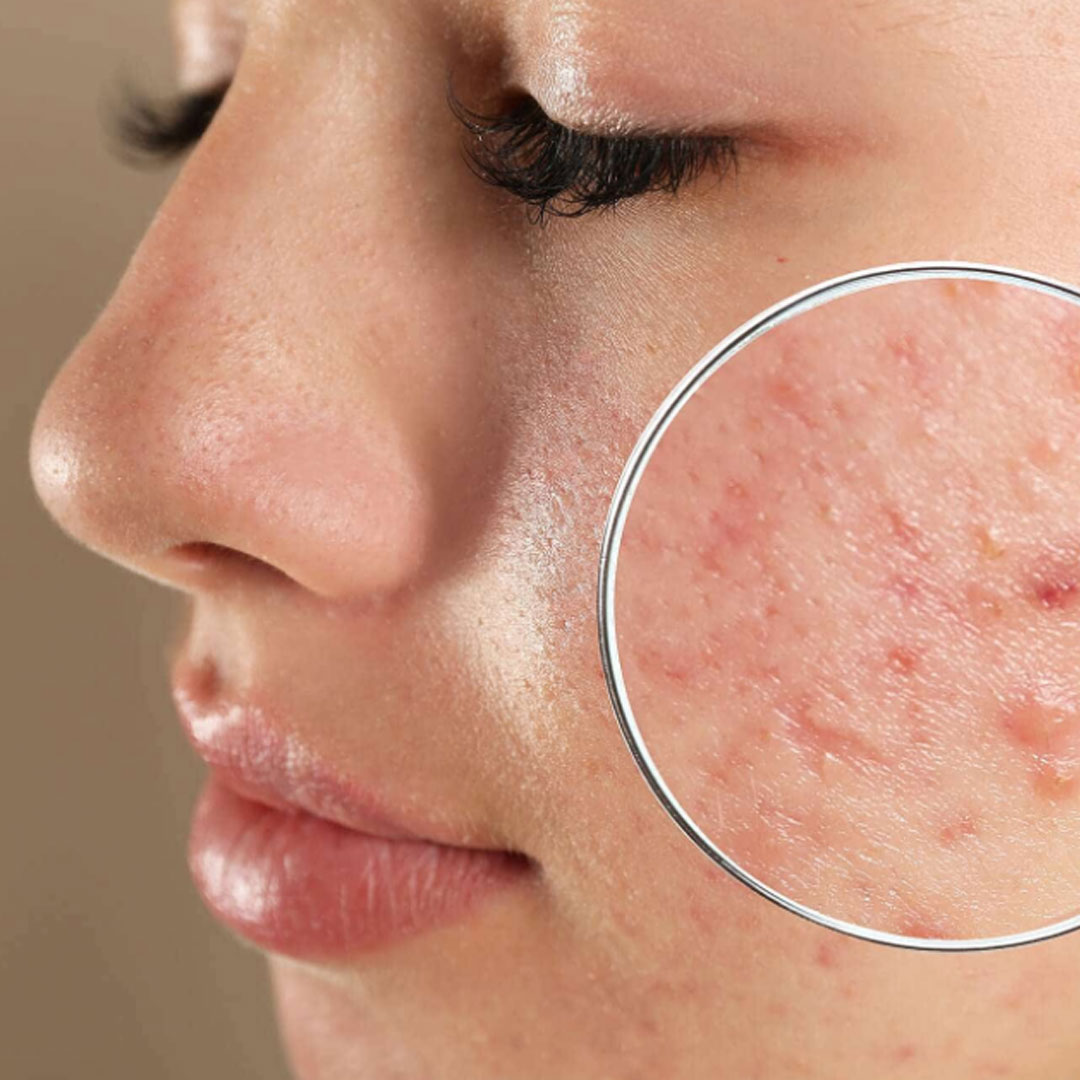 Best Acne Scar Treatment in Adilabad