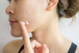 Best Acne Scar Treatment in Betul – Dr. Ayesha Faizan