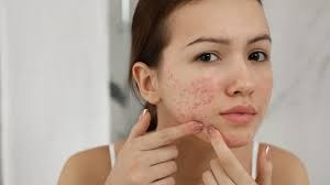 Acne Treatment in Betul – Dr. Ayesha Faizan