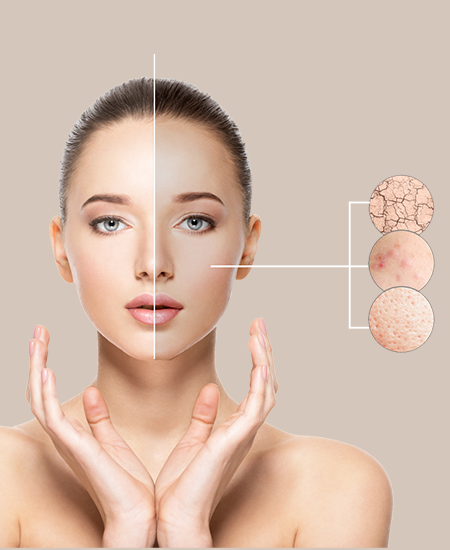 Acne Treatment in Durg