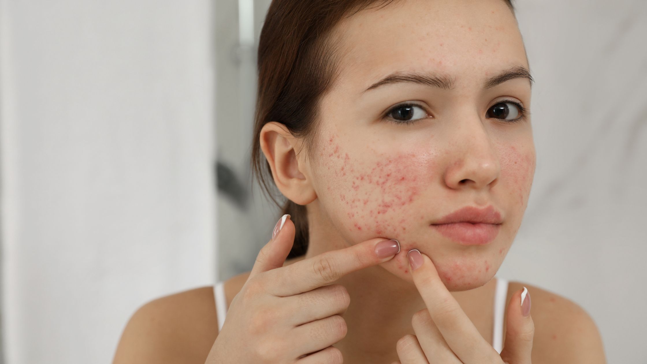 Acne Treatment in nagpur