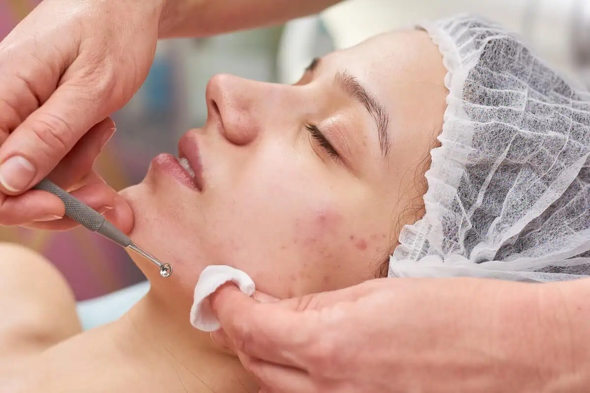 Best Acne Scar Treatment in Washim