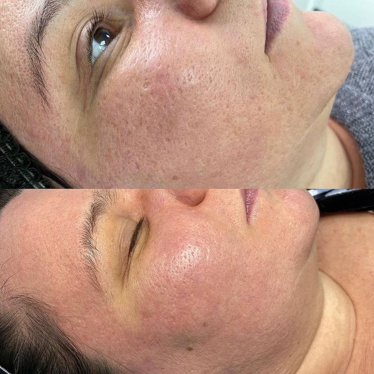 Best Acne Scar Treatment in Balaghat