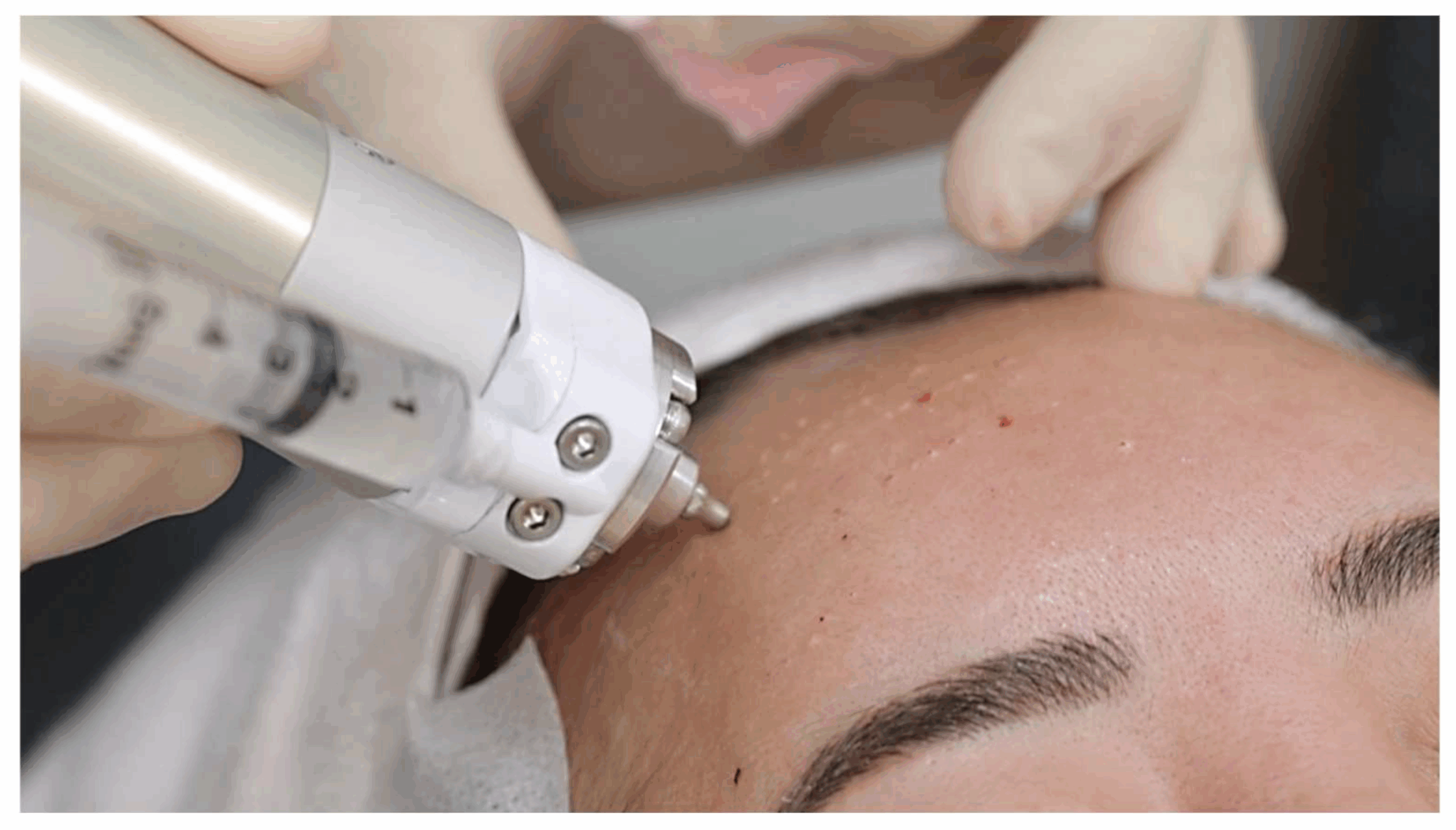 Best Acne Scar Treatment in Bilaspur
