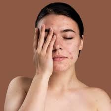 Acne Treatment in Adilabad