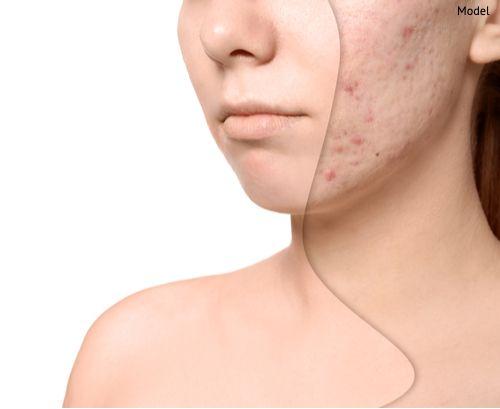 Best Acne Scar Treatment in Durg