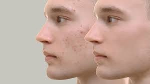 Best Acne Scar Treatment in Rewa