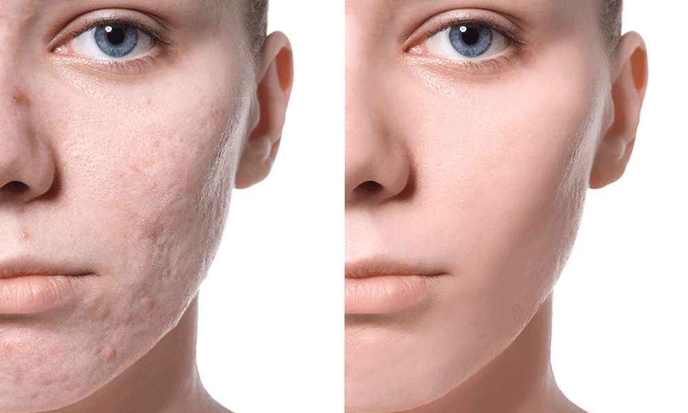 Best Acne Scar Treatment in Yavatmal