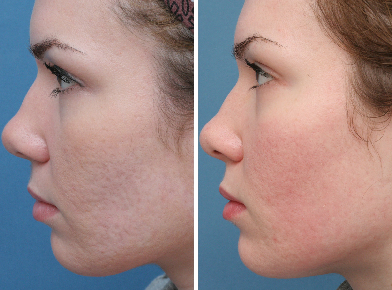Best Acne Scar treatment In Jabalpur