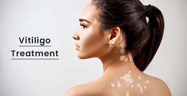 Best vitiligo treatment in nagpur