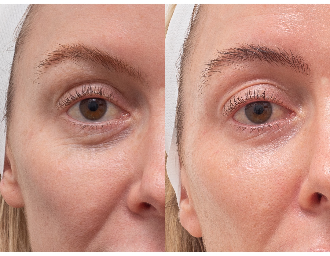 CO2 Laser Treatment In Nagpur