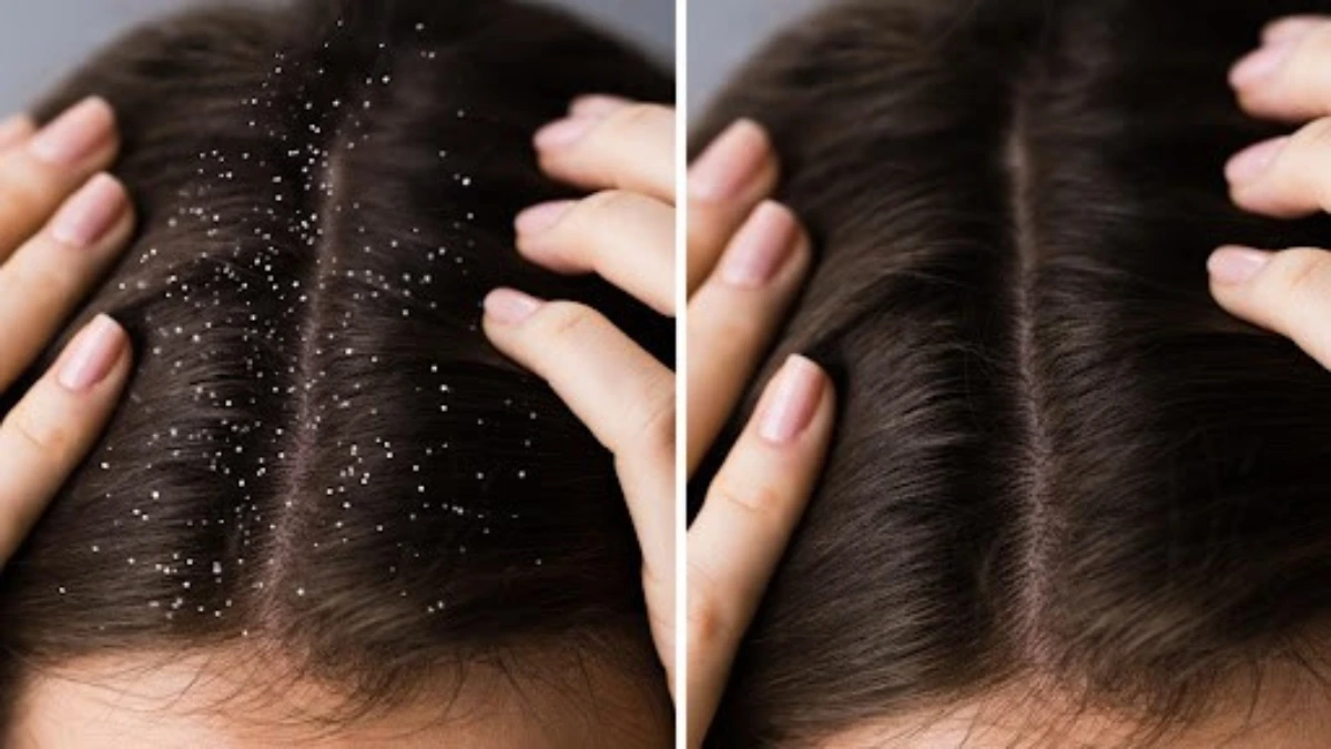 Dandruff Treatment In Nagpur