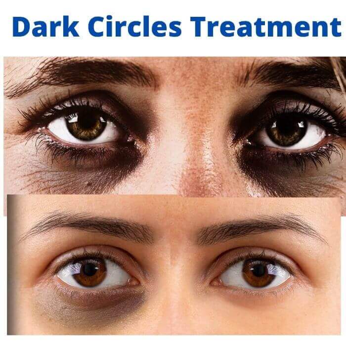 Dark circles treatment in nagpur