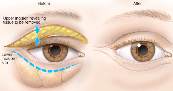 Drooping Eyelid Surgery Specialist In Nagpur