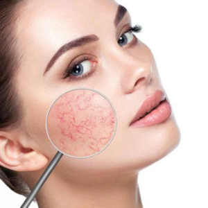 Best Acne Treatment in Gadchiroli