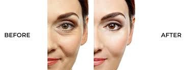 Filler Treatment in Buldhana