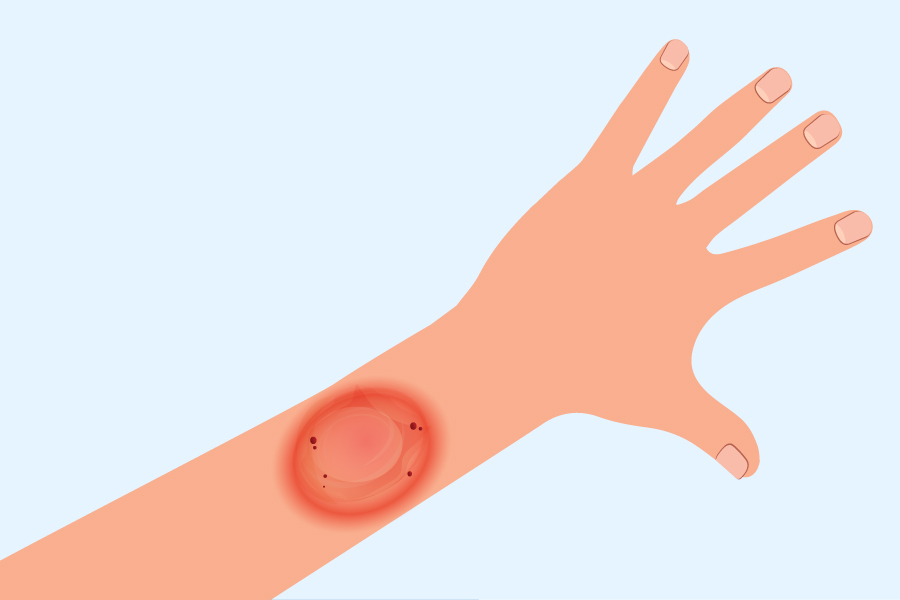 Fungal Infection Doctor In Pune